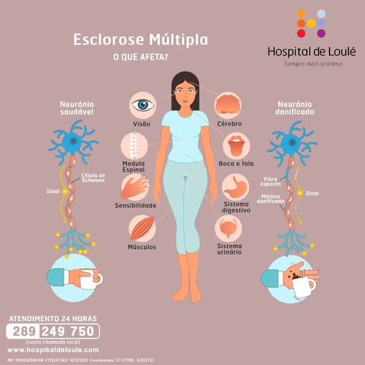 Multiple sclerosis